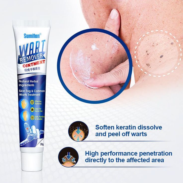 Wart Remover Ointment for Wart Removal