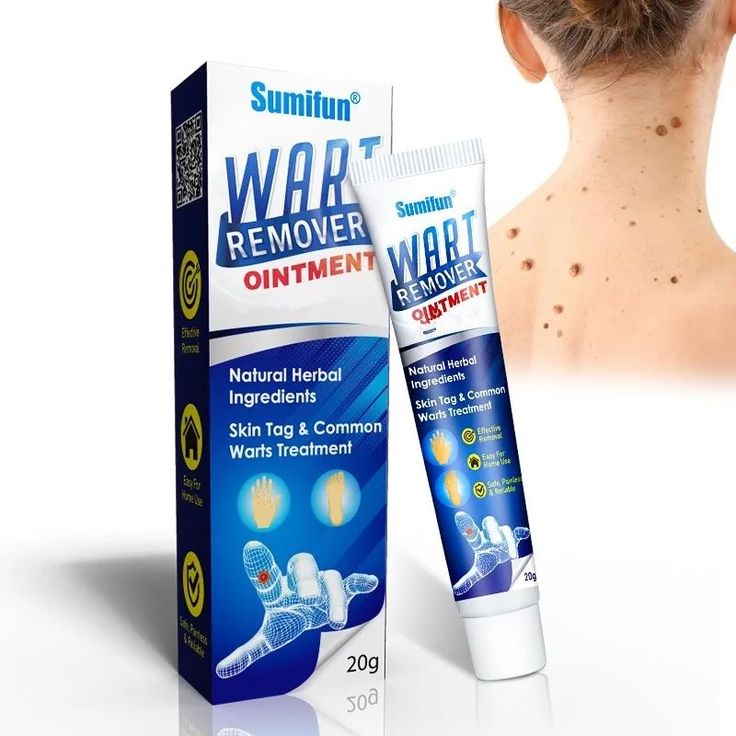 Wart Remover Ointment for Wart Removal